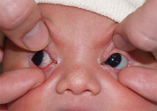 Eyes | Newborn Nursery | Medicine