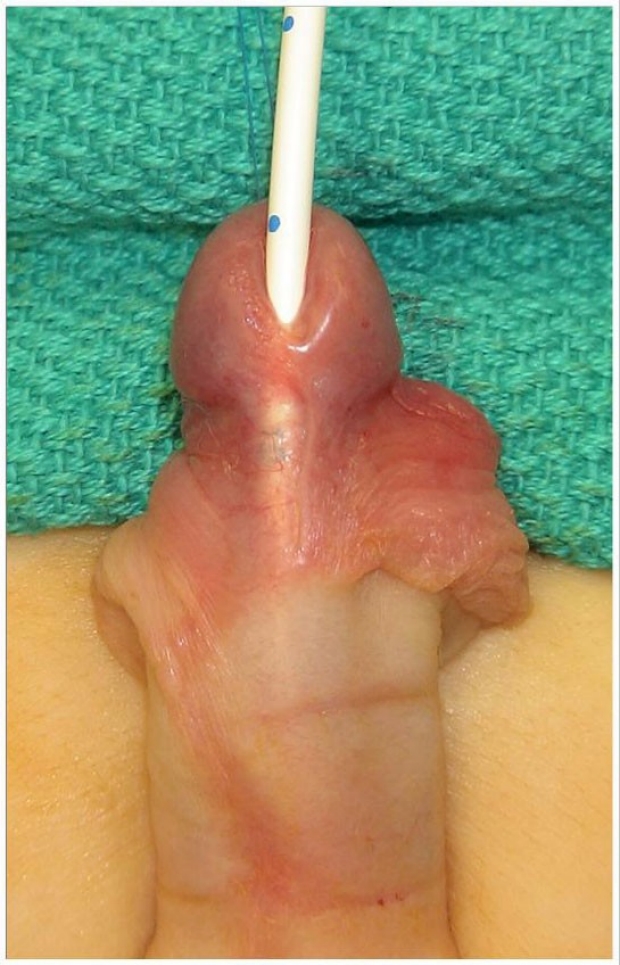 Hypoplastic Urethra