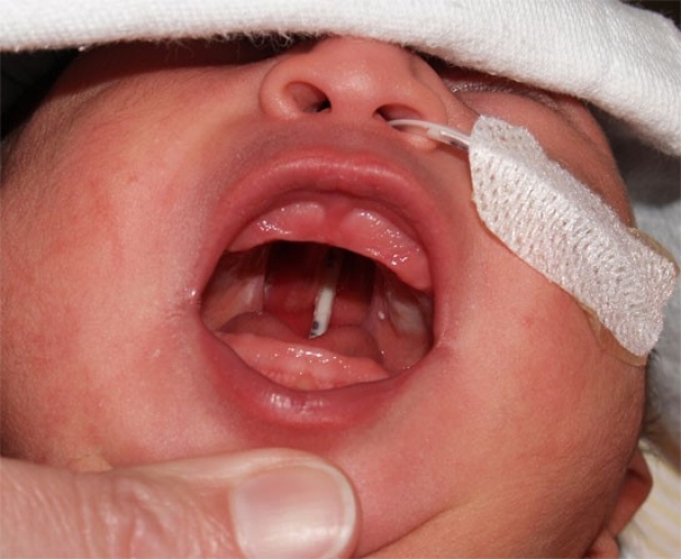 Cleft Palate