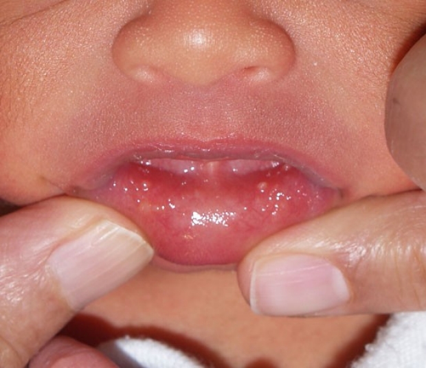 Mouth Newborn Nursery Stanford Medicine