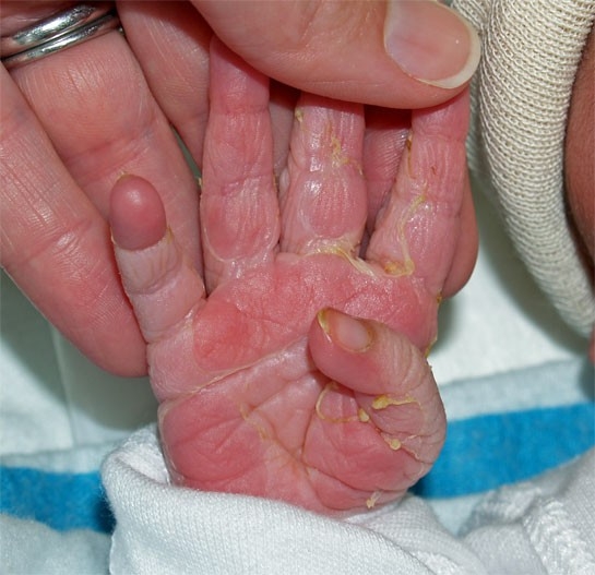 Baby's Ingrown Toenails: Prevention and Treatment