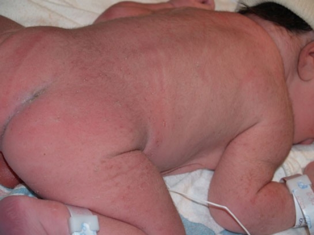 Transient Neonatal Pustular Melanosis