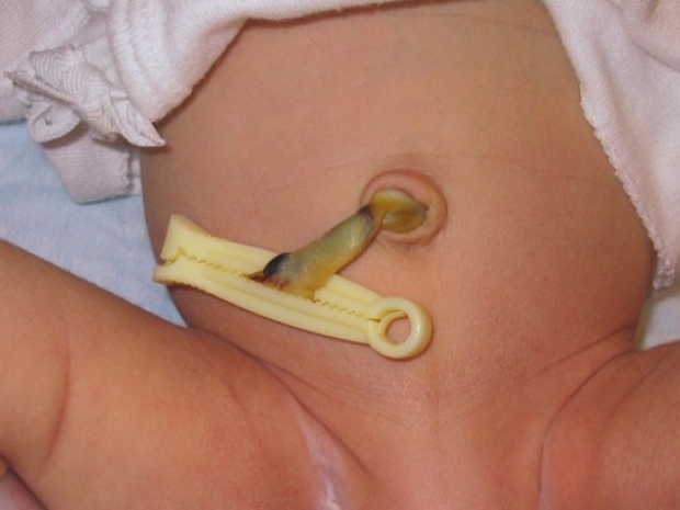 Normal Umbilical Cord