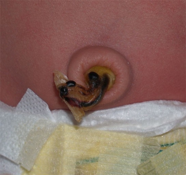 Normal Umbilical Cord dry