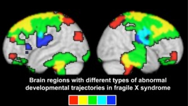 Imaging study discovers brain development differences in kids with Fragile X syndrome