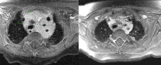 MRI scans of a hemangioma