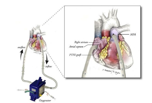 Bridge-to-transplant diagram