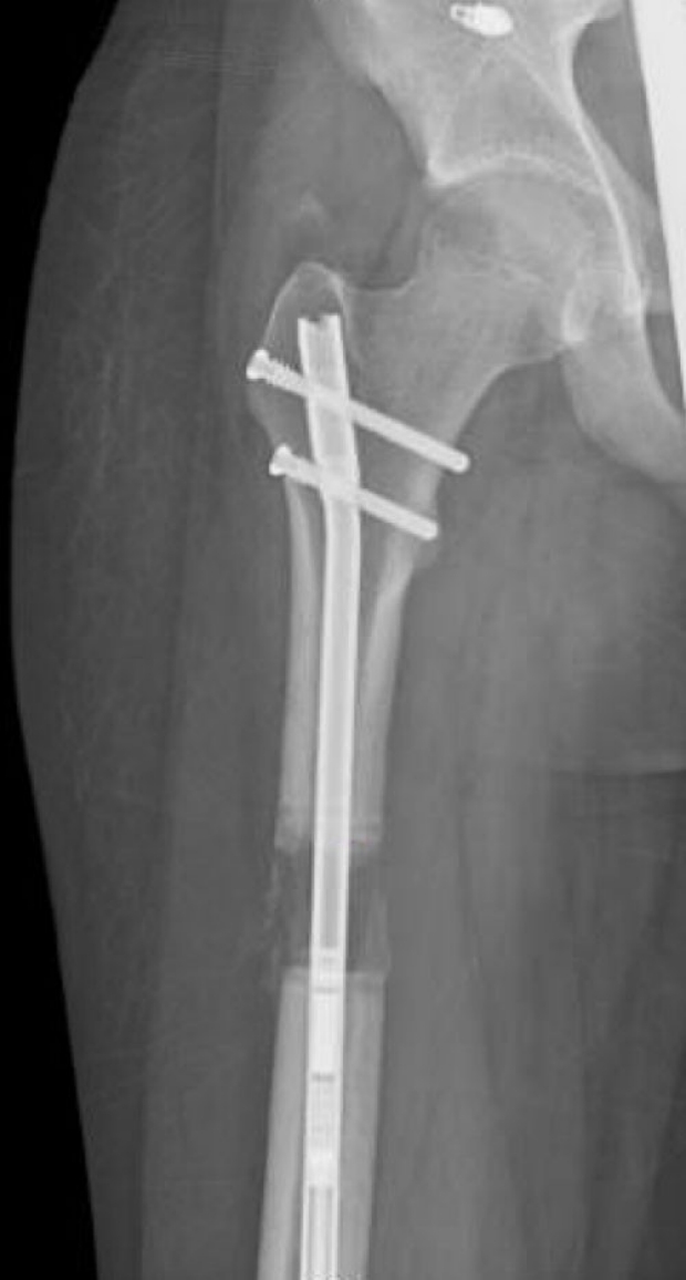 X-ray image of a leg with a bone-lengthening device