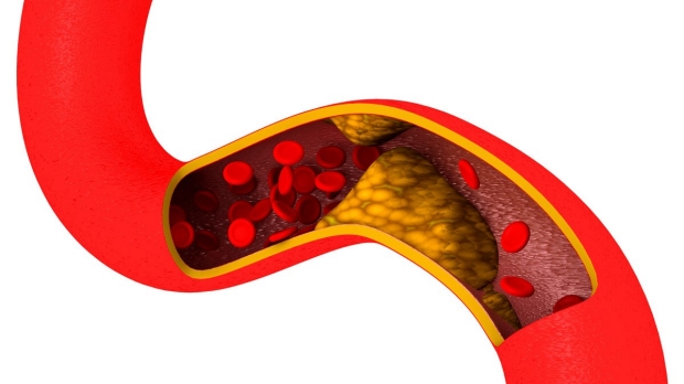 Antibodies could counter atherosclerosis