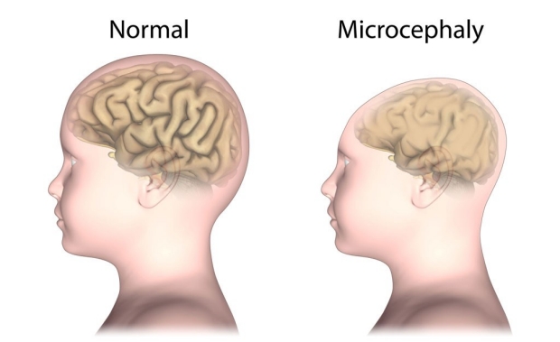 Illustration of a normal head and one affected by microcephaly