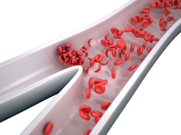 Illustration of sickle-shaped blood cells in a vein
