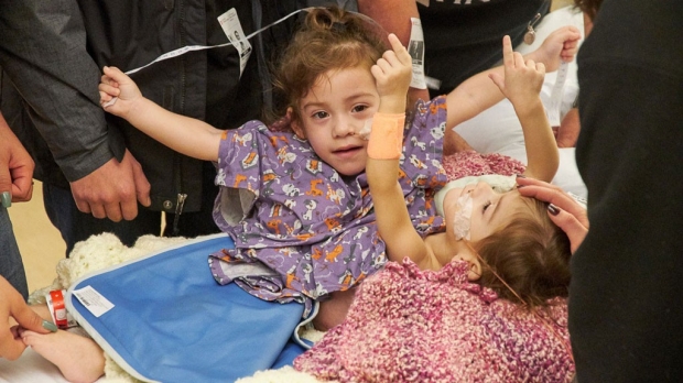 Conjoined twins successfully separated at Packard Children’s Hospital