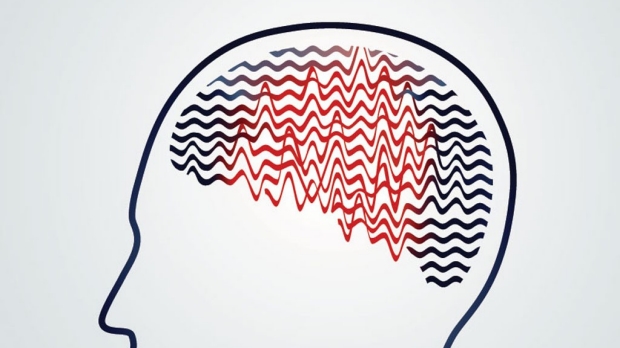 Research locates absence epilepsy seizure ‘choke point’ in brain 