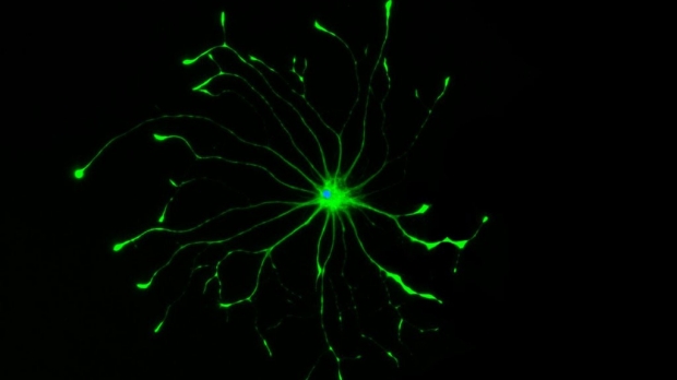 Toxic brain cells may drive neurologic disease
