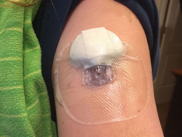 Close-up of the sensor inserted in a young girl's arm and covered with a clear plastic bandage