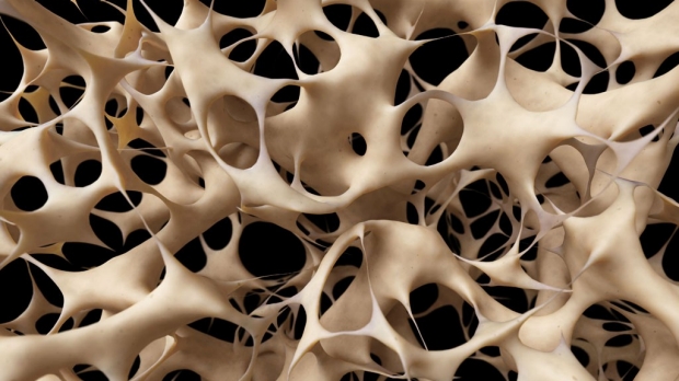 Genetic screen predicts osteoporosis risk