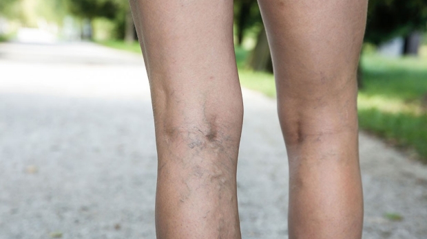 Height may contribute to varicose veins