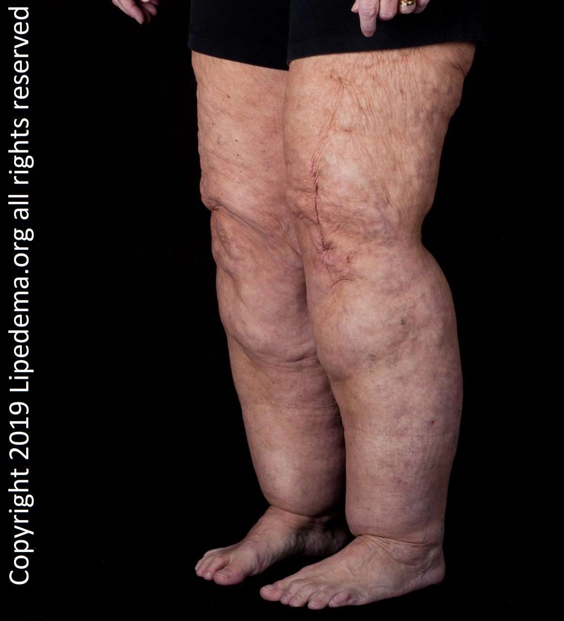 Exploring the Surgical Treatment of Lipedema with Lymphatic