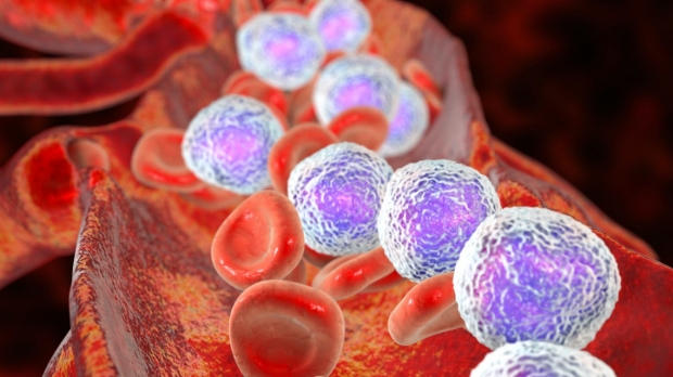 Study predicts who may benefit from CAR-T cell therapy for blood cancers