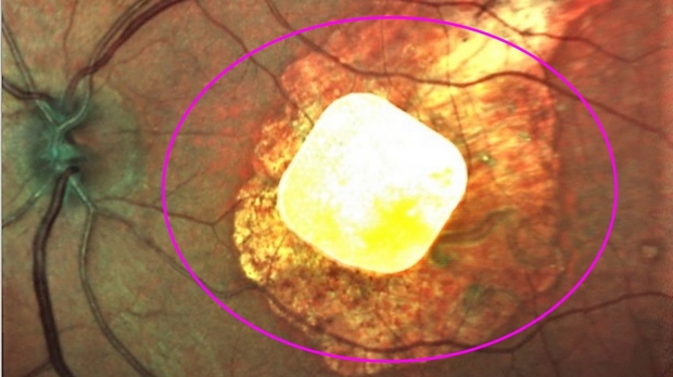Implanted chip, natural eyesight coordinate vision in study of macular degeneration patients
