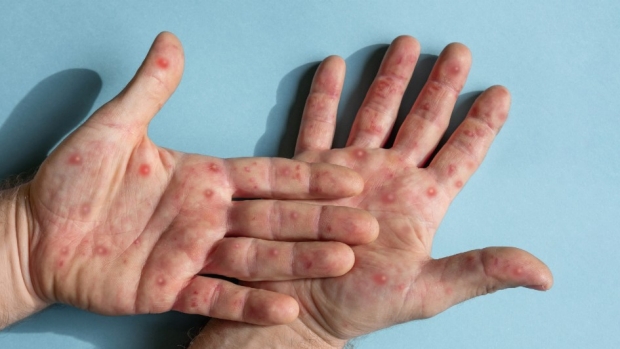 App recognizes suspected mpox rashes using artificial intelligence