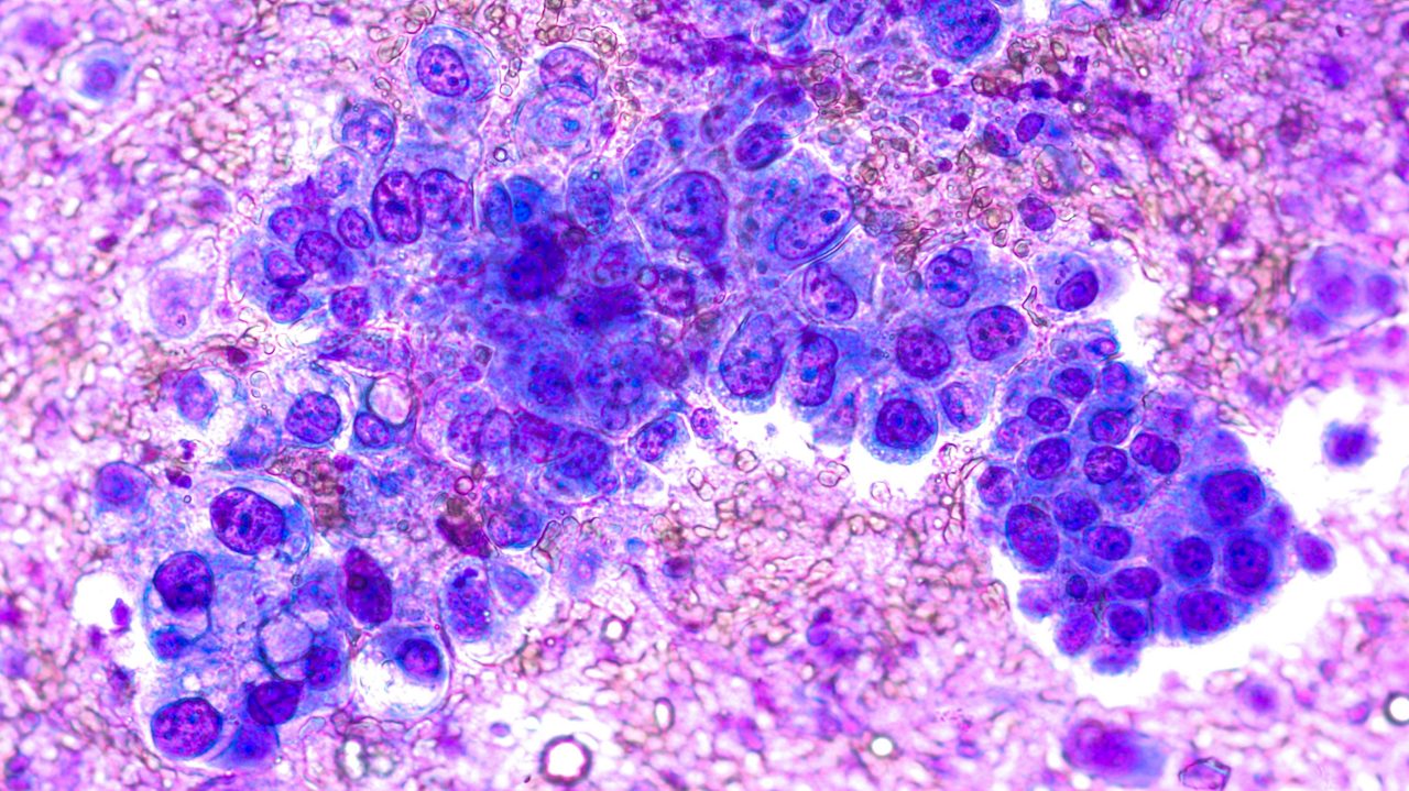 Phogomicrograph of fine needle aspiration (FNA) cytology of a pulmonary (lung) nodule showing adenocarcinoma, a type of non small cell carcinoma.