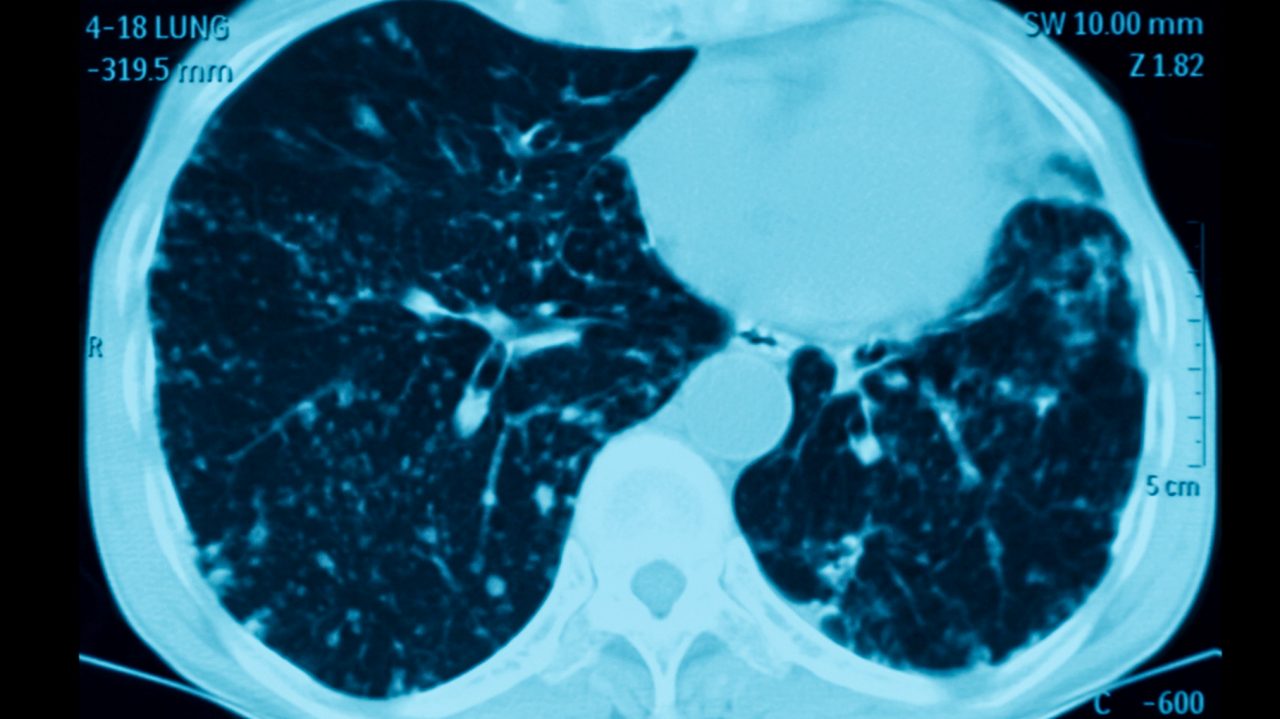 CT scan (computed tomography) of chest, coronal view, showing pulmonary metastasis, lung cancer