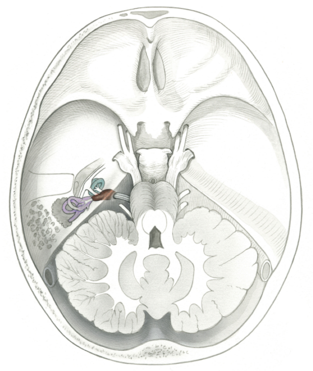 illustration of skull base tumor