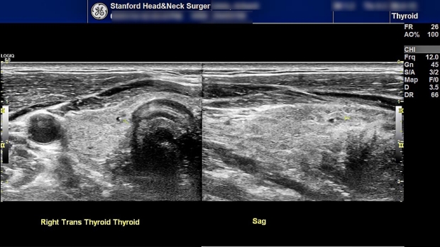 thyroid ultrasound images