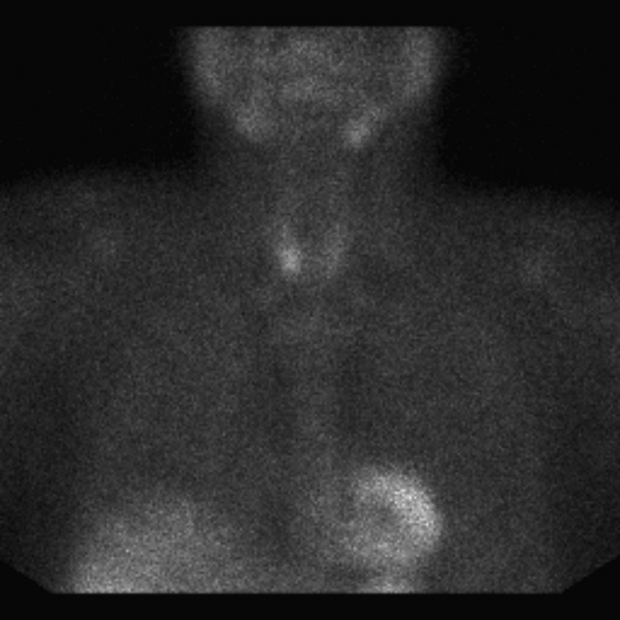 Sestamibi parathyroid scan (right) showing a bright signal in the right side of the neck at the site of a parathyroid adenoma.