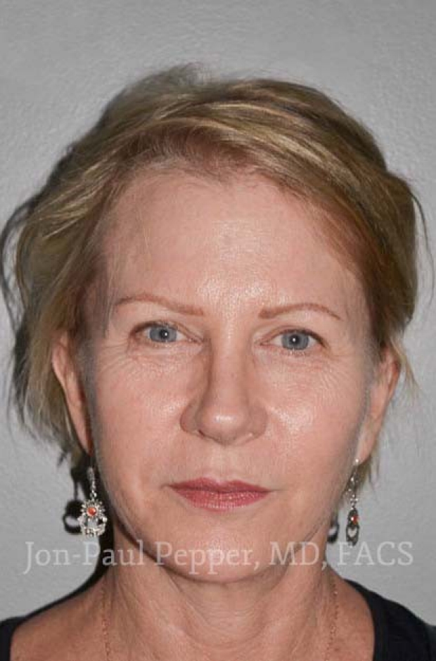 short scar facelift straight view after 6 months