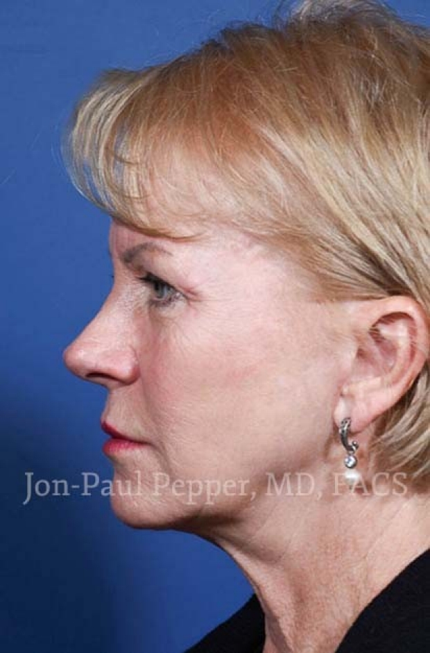 short scar facelift profile after 5 years