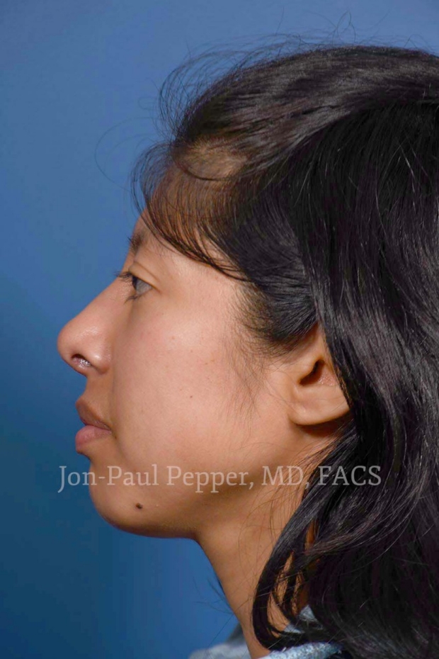 rhinoplasty lateral patient after
