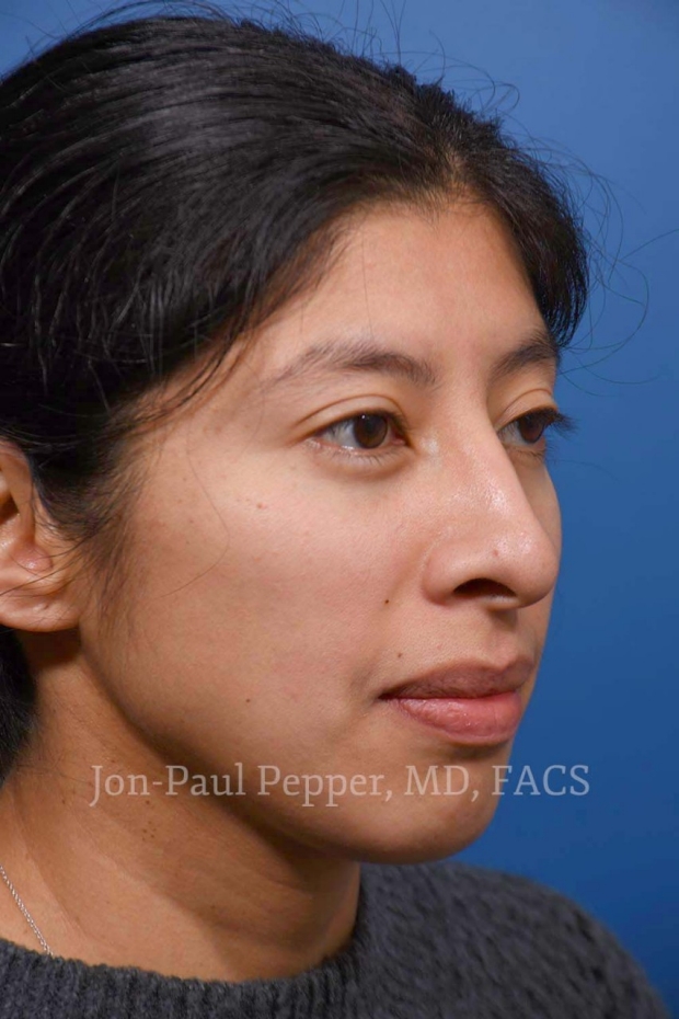 rhinoplasty oblique patient after