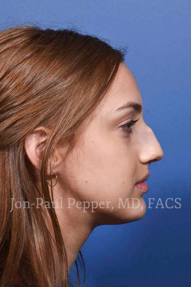 rhinoplasty patient A before