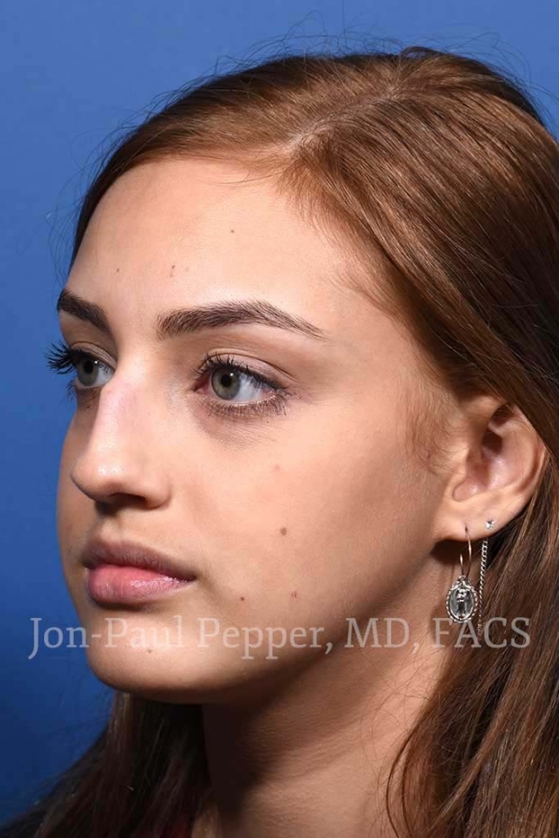 rhinoplasty patient A before