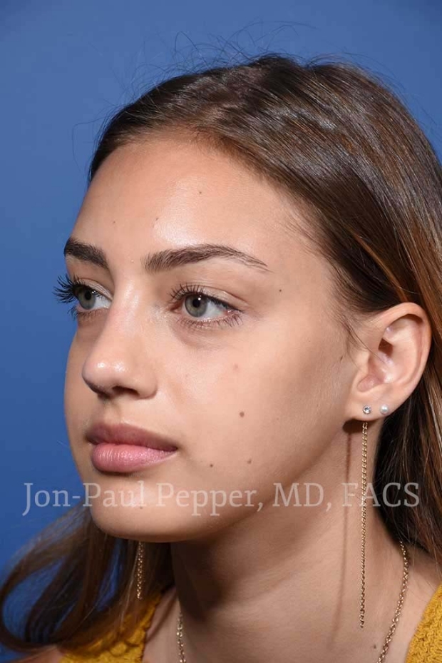 rhinoplasty patient A after