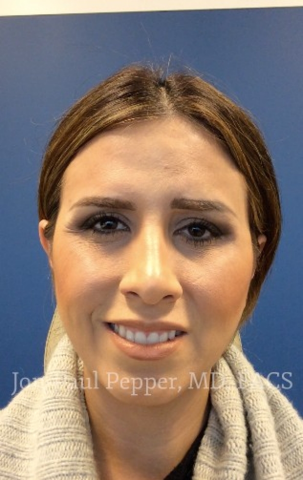 endoscopic browlift patient before
