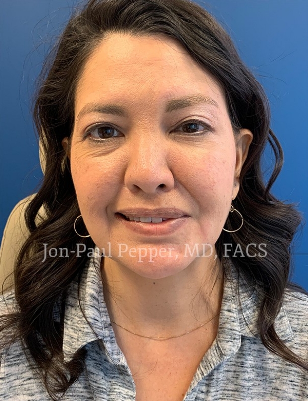 Selective Neurectomy, Endoscopic Browlift, and Upper Lid Blepharoplasty patient after