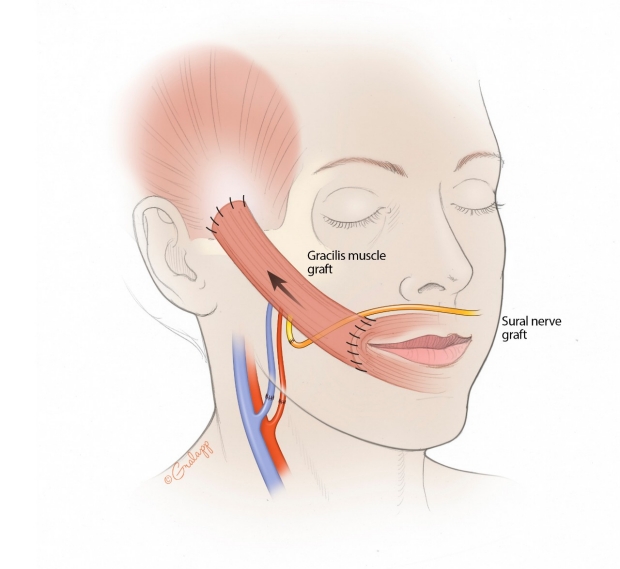 Figure 2: Illustration of Gracilis free muscle transfer once reattached in the face.