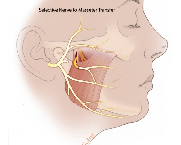 Selective Nerve to Masseter Transfer
