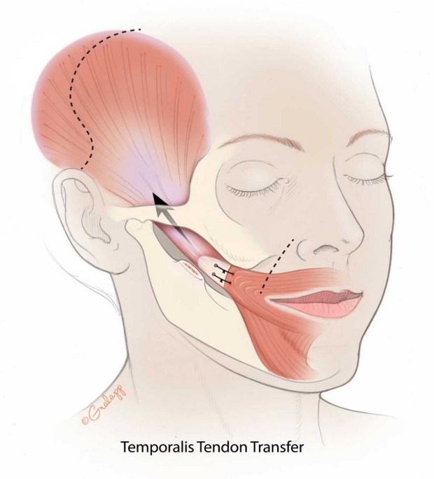 Temporalis Tendon Transfer