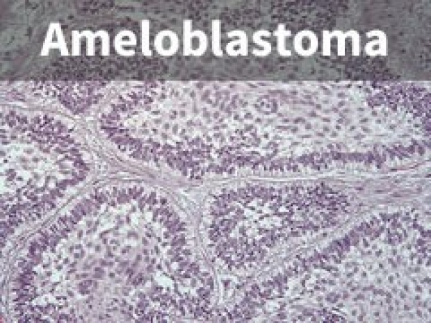 Ameloblastoma