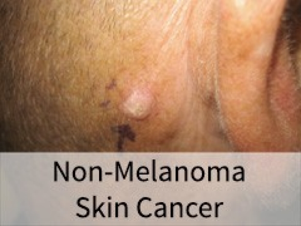 Non-Melanoma Skin Cancer