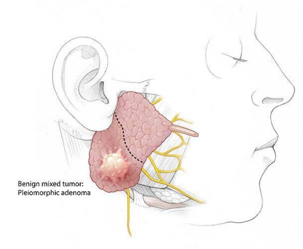 Benign mixed tumor: pleiomorphic adenoma