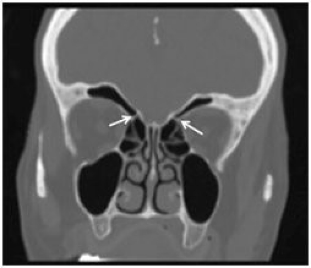 X-ray emphasizing blood supply in the nasal cavity