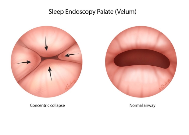 Sleep Endoscopy