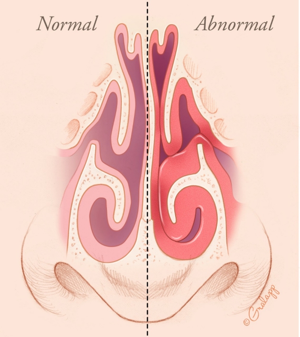 Nasal passages normal and abnormal