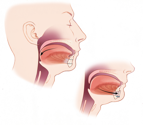 Tongue Surgery Post-Op Instructions
