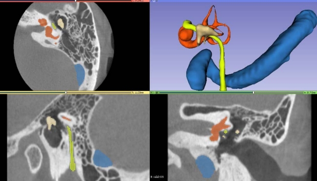 Collage of photographs for The generation of segmented anatomic models from a clinical CT scan through the application of artificial intelligence algorithms.